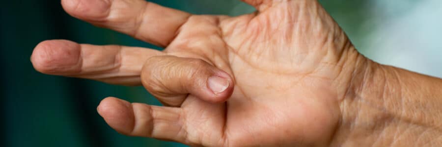 schnellendefinger | Schnellender Finger (Ringbandspaltung) Behandlung Wien | Dozent Dr. Matiasek | Schönheitschirurg Wien